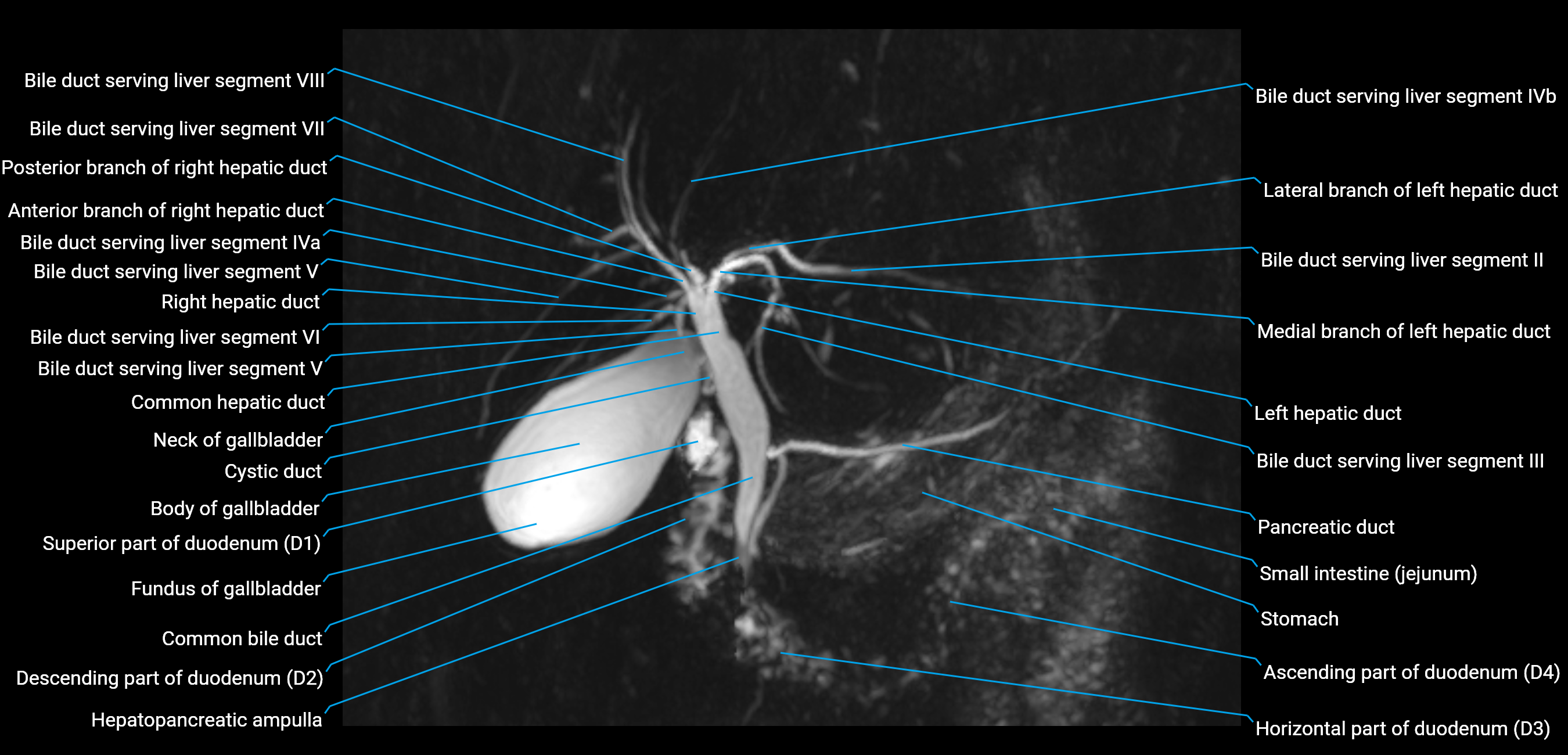 MRCP MIP MRI  anatomy labelled image-img-01003-00011.png